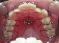 Step4 床矯正装置の装着